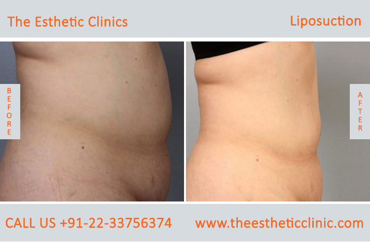 Liposuction Fat Removal Treatment before after photos in mumbai india (2)